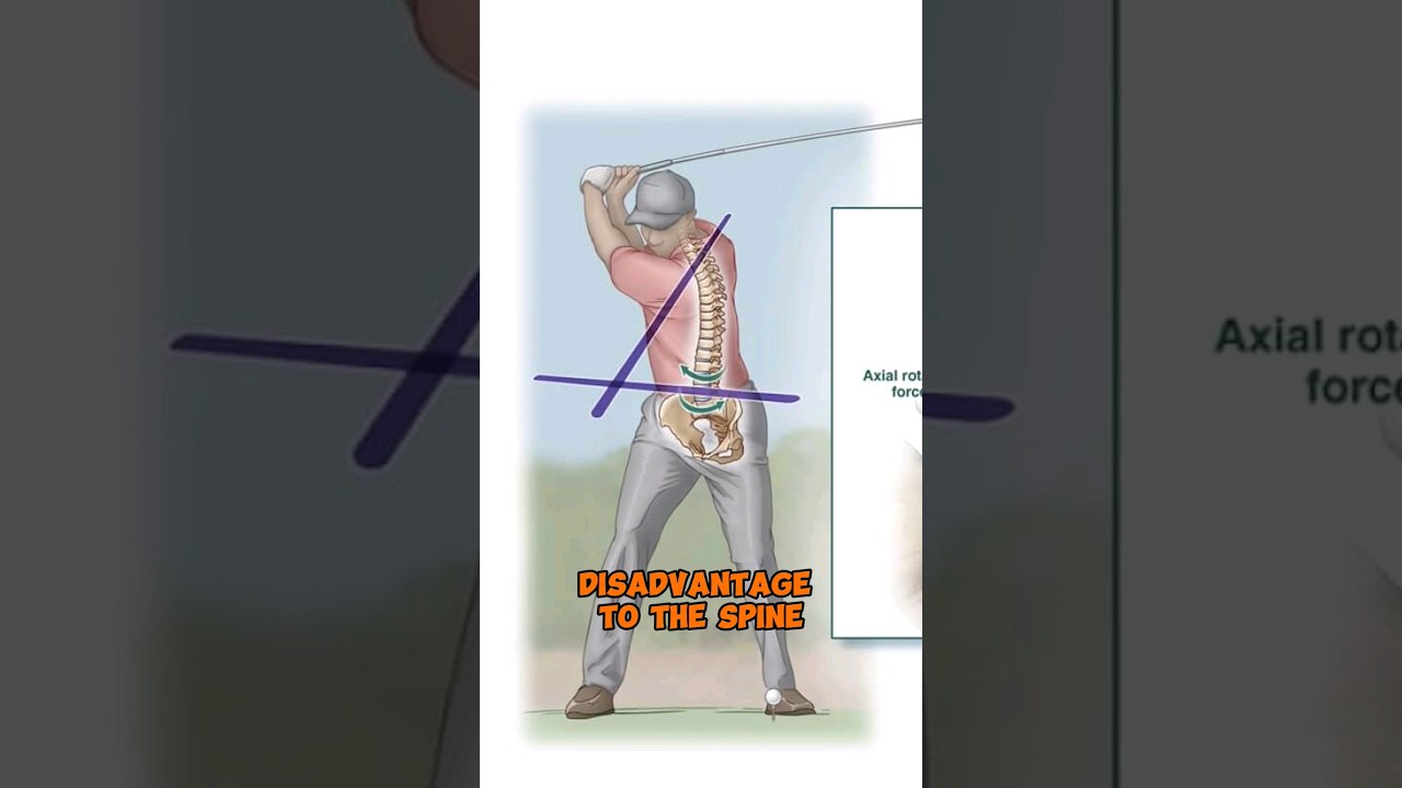 LOW BACK PAIN IN GOLFERS