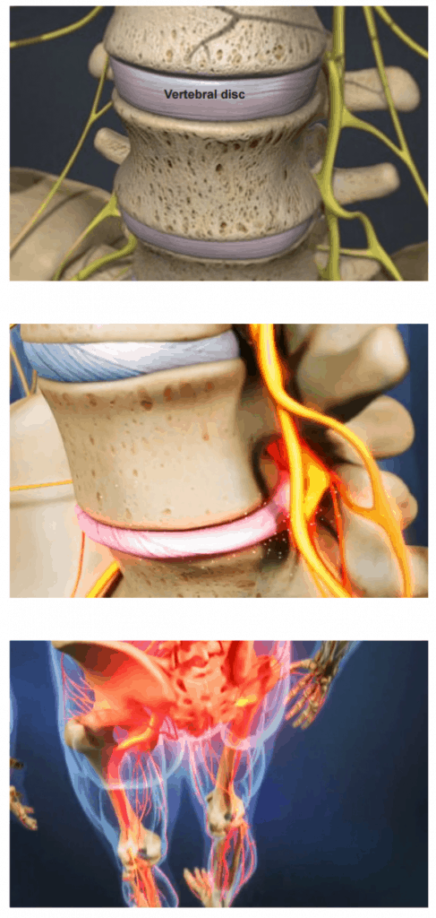 Degenerative Disc Disease