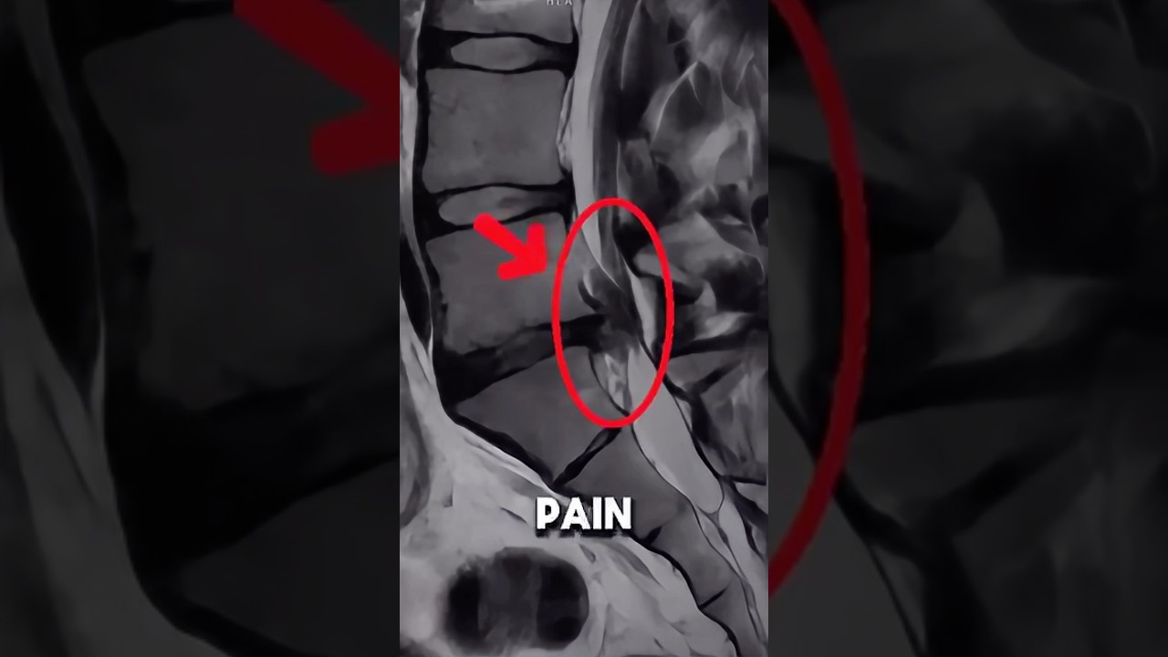 Does Size Matter With Disc Herniations?